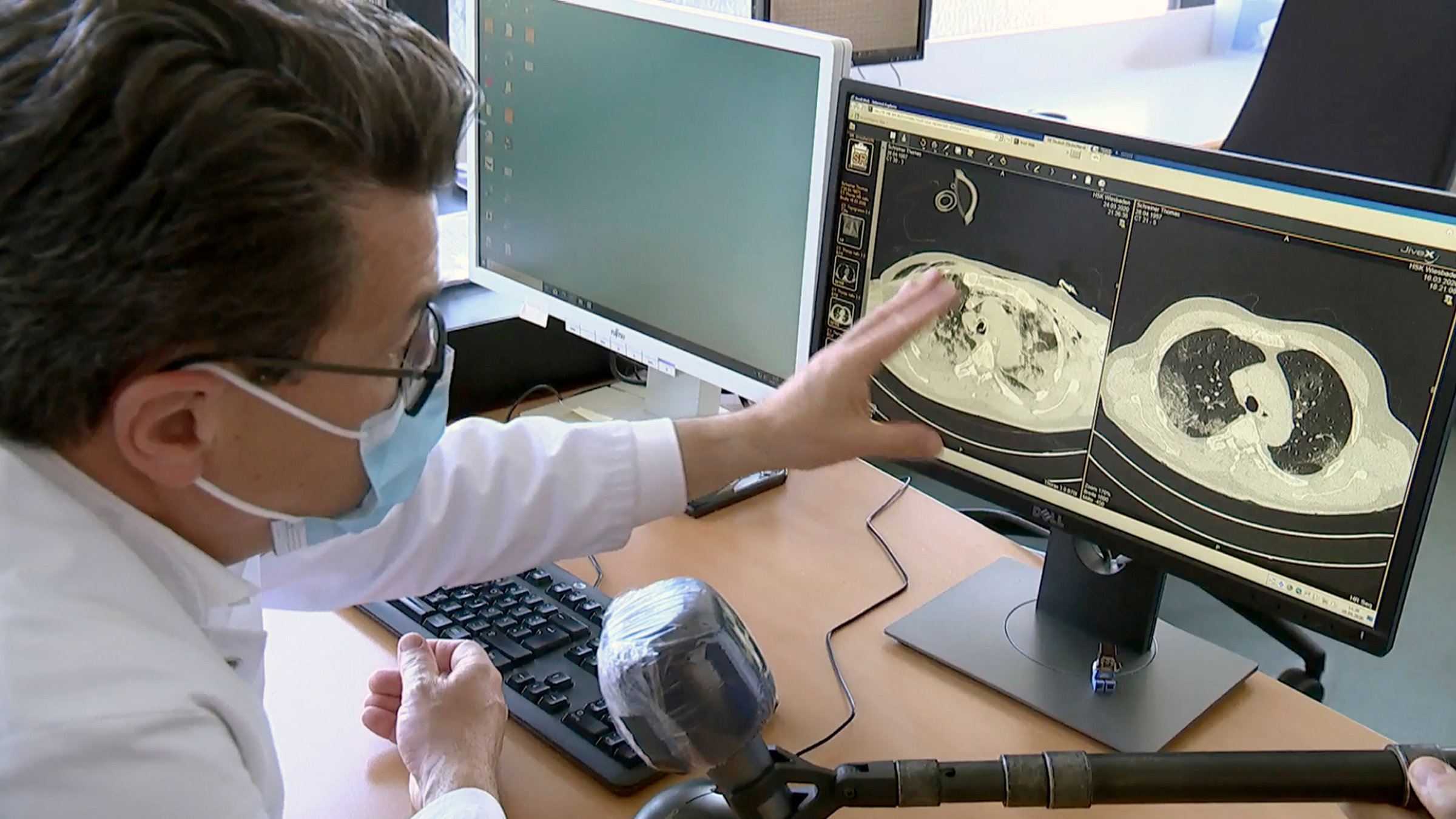 "Hessenreporter: Covid 19 - erstmal überleben ... und was dann?": Prof. Dr. Tobias Bingold von der DKD Helios Klinik in Wiesbaden erklärt die Entwicklung der Covid19-Erkrankung anhand zweier Lungen-MRT-Aufnahmen, die in 14-tätigem Abstand gemacht wurden.